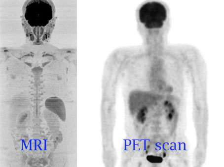 What the difference a PET scan and MRI? – Aim Medical Imaging